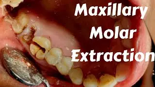 Maxillary Molar Extraction By Split & Section Technique & Complication || Exodontia Lecture