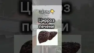 ЧИТАЙ ЗАКРЕП В КОММЕНТАРИЯХ ➡️➡️ #цирроз #печень #жировойгепатоз #фармацевт