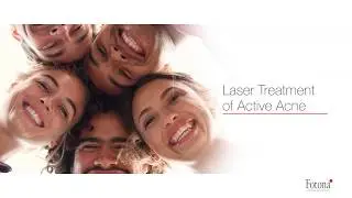 Active Acne, Laser Treatment