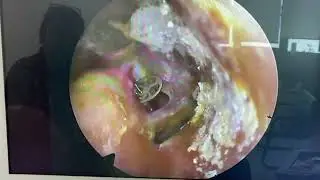 Prosthesis extrusion post total ossicular replacement ossiculoplasty (TORP)