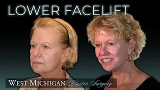 LOWER FACELIFT - What to Expect? Recovery? Natural Looking?