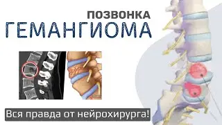 ГЕМАНГИОМА позвонка! Вся правда от нейрохирурга!