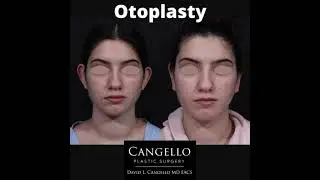 Otoplasty (Ear Pinning) Surgery Video