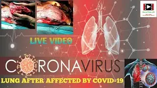 Covid-19 affected Lung vs. healthy Lung||Covid19 lung damage