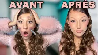 BOTOX TO SYMMETRIFY MY LIPS