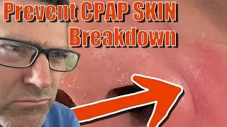 CPAP Skin Breakdown: Prevent CPAP Related Dermatitis