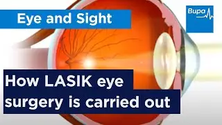 How LASIK eye surgery is carried out | Bupa Health
