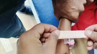 cannulation.. long videos.. part 62 