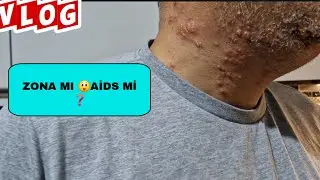 ZONA'MI⁉️AİDS'Mİ❌️HERPES GECE YANIĞI⁉️ANTİVİRAL❌️BULAŞICIMI⁉️VİRÜS🤔