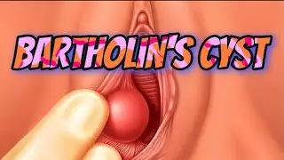 Bartholin’s Cyst|Causes,Symptoms| Diagnosis,Treatment
