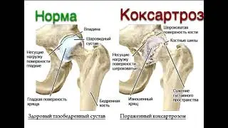 Как я одолел коксартроз