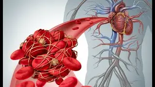 Thrombosis