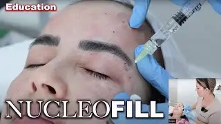 NUCLEOFILL injection techniques full face and eyes (2024)