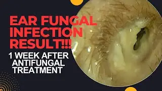 RESULT Of Antifungal Treatment In Otomycosis After 1 WEEK!