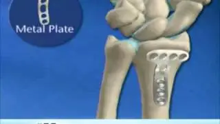 Wrist Fracture Repair