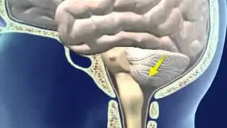 Brainstem Herniation