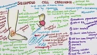 Squamous Cell Carcinoma | Pathology