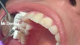 Tooth Decay Treatment   !!!!!