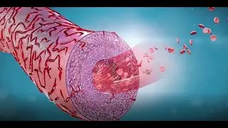 New thesis on the cause of arteriosclerosis