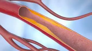 Peripheral Artery Disease