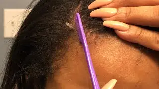 Dandruff Scratching: Big Flakes, Minimal Talking, Pt. 2