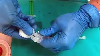 Use of a novel chyme reinfusion device during damage control surgery to improve nutritional status