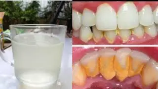 best top remedy to remove tartar cavity bad smell from teeth at home teeth white like pearl