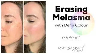 Erasing Melasma with Demi Colour