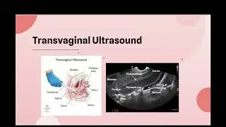 Ultrasound and Saline Infusion Sonography SIS in Diagnosing Leiomyomas & Endometrial Polyps