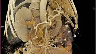 Pancreatic Cancer with Preop Staging with Cinematic Rendering