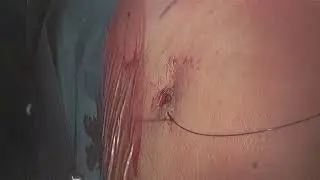 LATERAL COLPOSUSPENSIONS FOR  MULTICOMPARTIMENTAL PROLAPSE - POPS