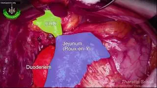 Recurrence biliary stenosis, Hepaticojejunostomy (Educational Uncut)