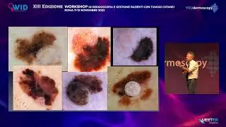 XIII Workshop - G. Argenziano - Update diagnosi tumori cutanei