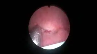 Total Endoscopic VVF Repair