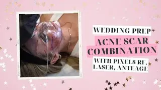 PATIENT STORY | WEDDING PREP ACNE SCAR COMBINATION WITH PIXEL8 RF, LASER, ANTEAGE| Dr. Jason Emer