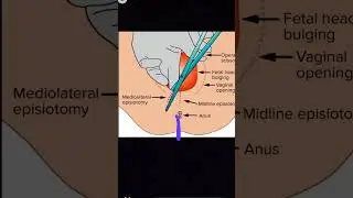 Obstetrics Episiotomy types viva