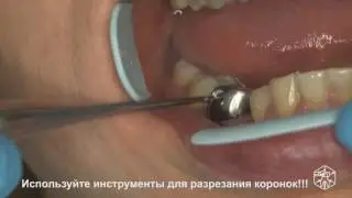 Применение WamKey - снятие коронки 003 - (коронковые ключи WAMKey отзывы)