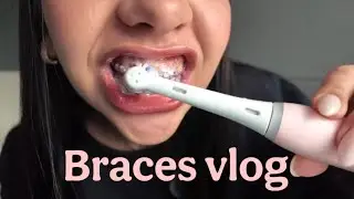 Braces Vlog #6: The Glow Up Is REAL 🦷