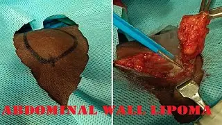 Abdominal wall intermuscular lipoma| Excision and biopsy| Dr. Pandiaraja