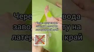 вальгус стопы | пвдс
