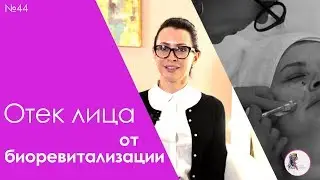 Биоревитализация вызывает отек лица?