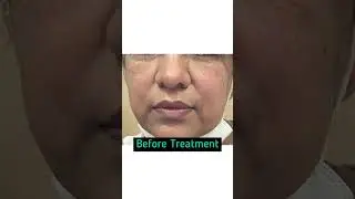 Skin Rejuvenation Treatment in Chandigarh | Dr Ashima Goel MD Dermatologist|Carbon divine treatment