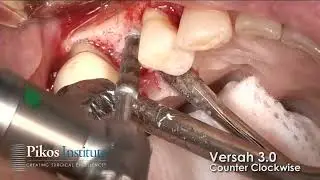 Crestal Approach Sinus Graft Using  Osseodensification and Novabone with Immediate Implant Placement