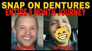 My Snap on Denture Journey: From Pain to Perfect Smile