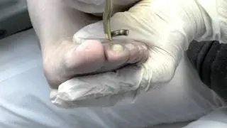 Laserbehandlung gegen Nagelpilz