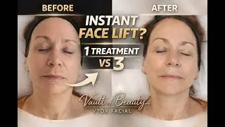 VTOX Facial at Vault of Beauty | Instant Lift, Tightening & Glow