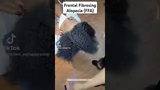 Hair Replacement for Frontal Fibrosing Alopecia by Houston Hair Loss Specialist. #alopeciadoctor