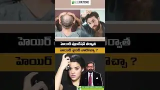 Hair Fiber After Hair Transplant || #hairfibers #hairtransplantsolutions #shorts #ytshorts