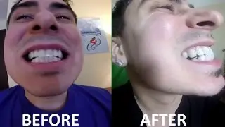 Crest 3D White Strips LUXE Teeth Before & After Professional Effect