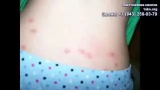 Укусы постельных клопов на людях и детях